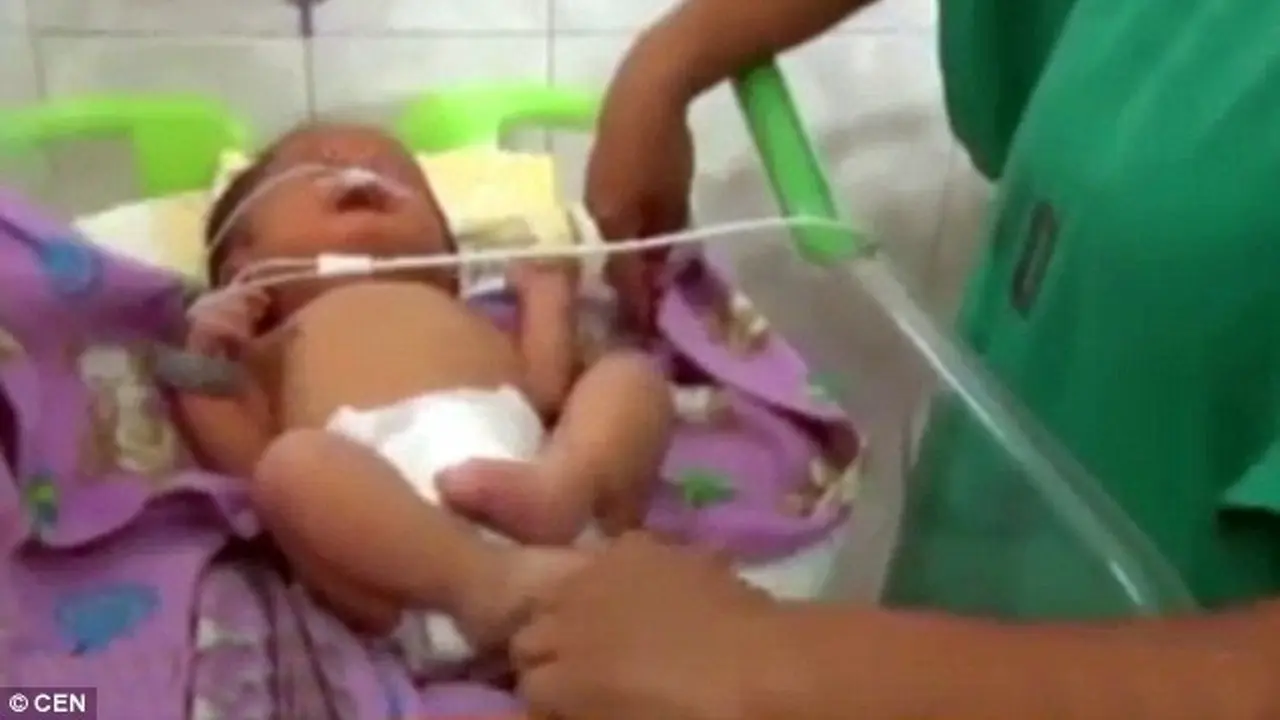 Bayi Terlahir dengan 2 Hidung Dekat Kening