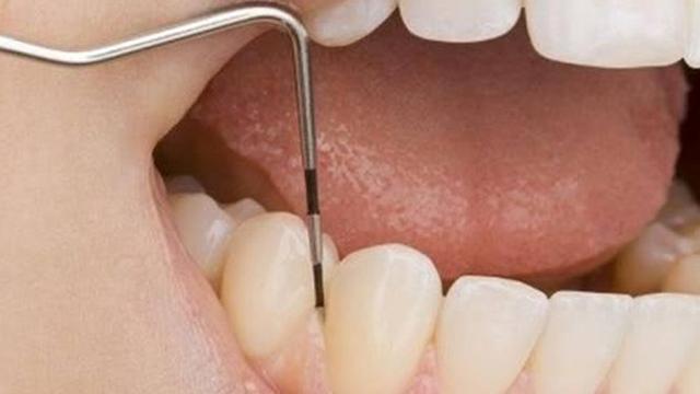 Ada Sesuatu yang Mengejutkan di Balik Gigi Ngilu, Jangan Anggap Sepele! -  Health Liputan6.com