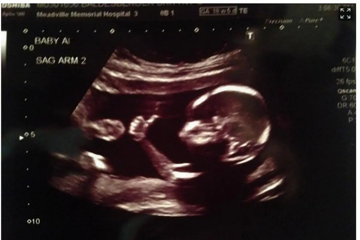 Jempolan! Bayi Ini Pamer Jempol Saat USG