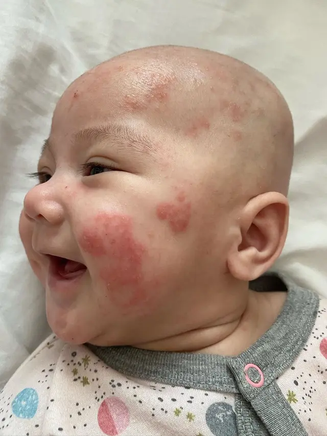 7 Potret Perjuangan Mona Ratuliu Rawat Anak yang Idap Dermatitis Atopik