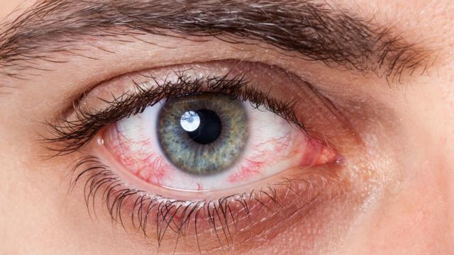13 Penyebab Mata Merah yang Umum dan Cara Mengatasinya - Hot Liputan6.com