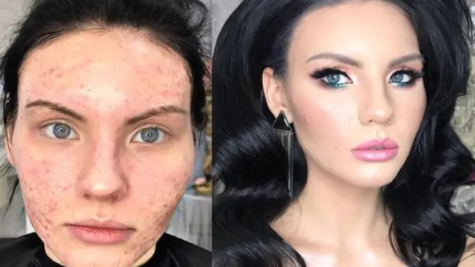 Cantik Kebangetan, Transformasi Wajah Berjerawat Setelah di Makeup Ini Bikin Pangling