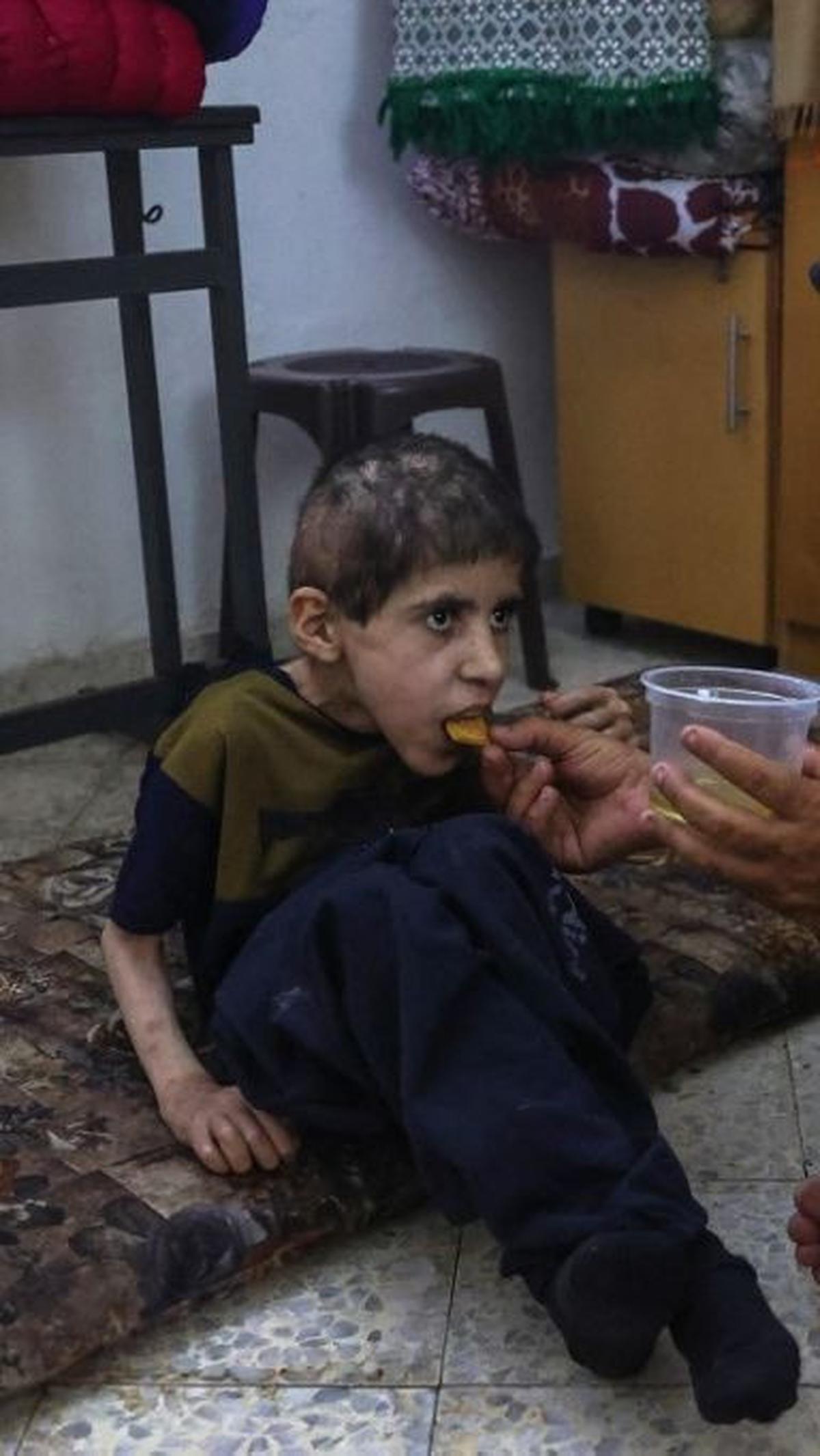Kondisi itu menyebabkan ribuan anak-anak di Jalur Gaza menderita kekurangan gizi. Termasuk, Bahaa al-Nimr yang mengidap kelumpuhan otak atau cerebral palsy.&nbsp;(Omar Al-Qattaa/AFP)