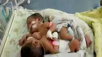RS M Jamil menyatakan kondisi kedua bayi kembar siam yang diberi nama Salwa dan Salma itu dalam kondisi sehat.
