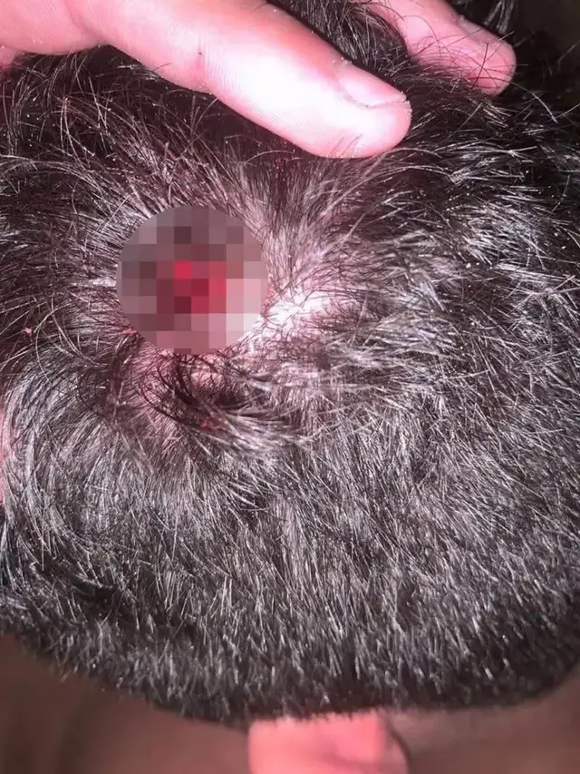 Pria Ini Tertembak di Kepala Dikira Kena Batu