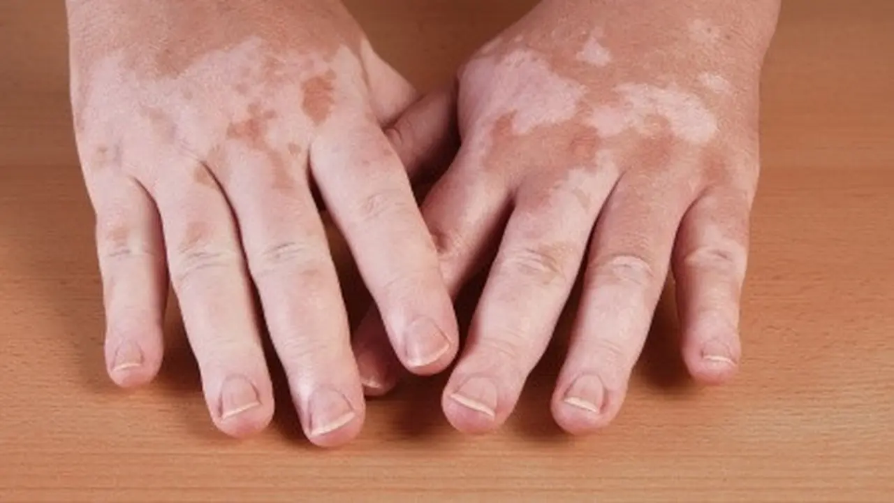 Vitiligo