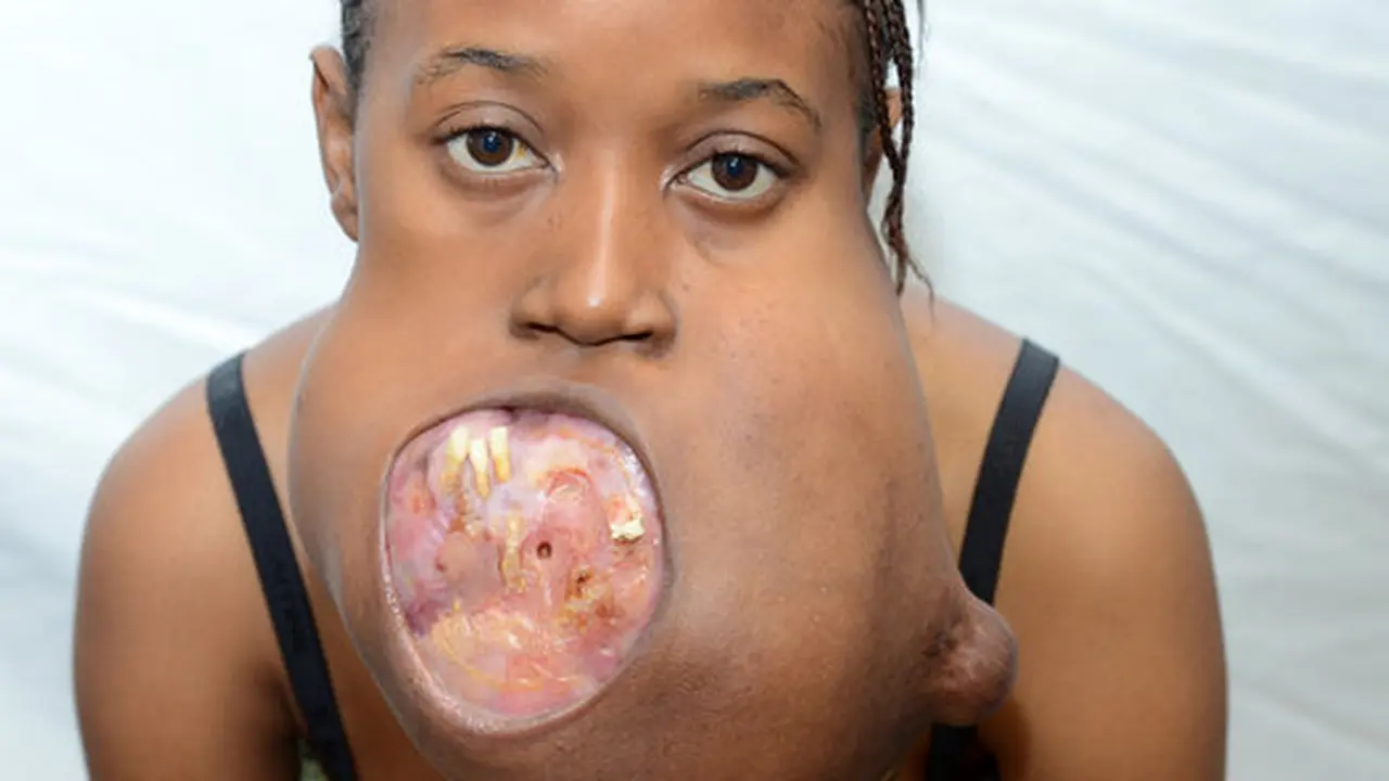 Grace, yang lahir di Republik Kongo memiliki tumor di bagian mulut. (Huffington Post)