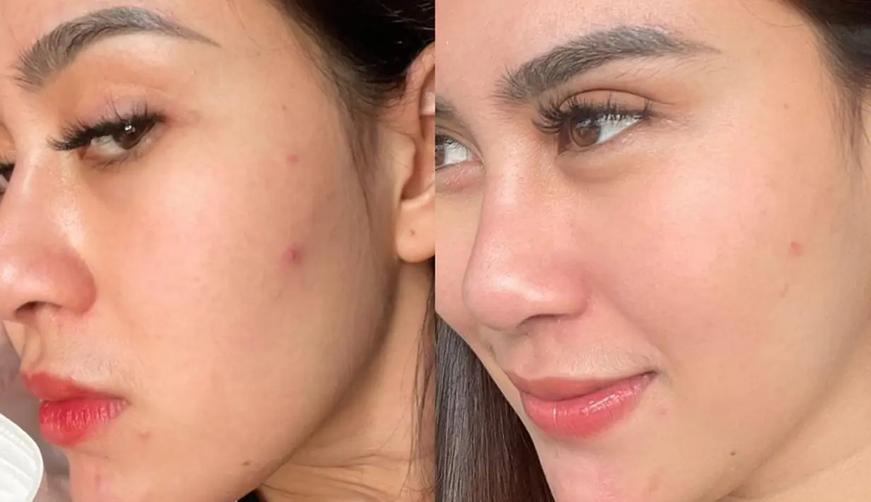 Bahkan ibu dua anak tersebut, tak segan memamerkan wajahnya saat berjerawat. Meski tengah berjerawat, Syahnaz Sadiqah tetap terlihat cantik. Penampilannya yang natural tanpa riasan itu tampak memesona. (Liputan6.com/IG/@syahnazs)