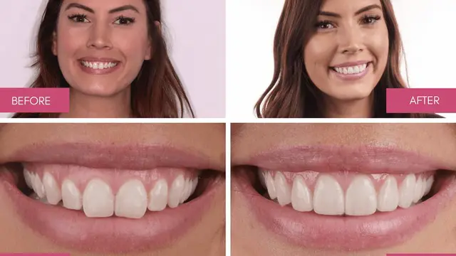 Bye Gummy Smile, Makin Percaya Diri dengan Senyum Cantik Tanpa Pamer Gusi