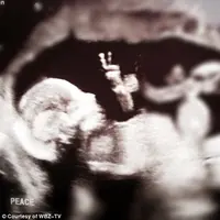 Foto USG diketahui bayinya mengacungkan dua jari seperti memberikan tanda perdamaian 'i come in peace'.