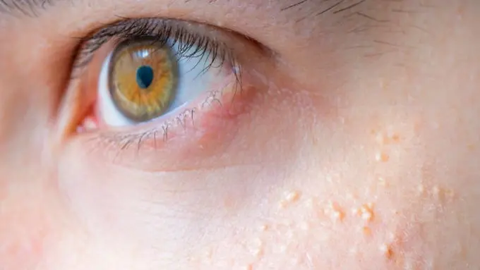 [Bintang] Atasi Jerawat Nasi dengan 3 Ramuan yang Bahannya dari Dapur Rumahmu Ini