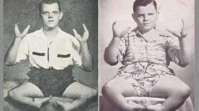 Terlahir Dengan Kondisi Langka, 5 Orang Ini Menjadi Tontonan Sirkus Di Masa Lalu