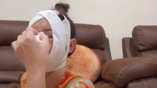 Wajah Bunda Corla Usai Oplas