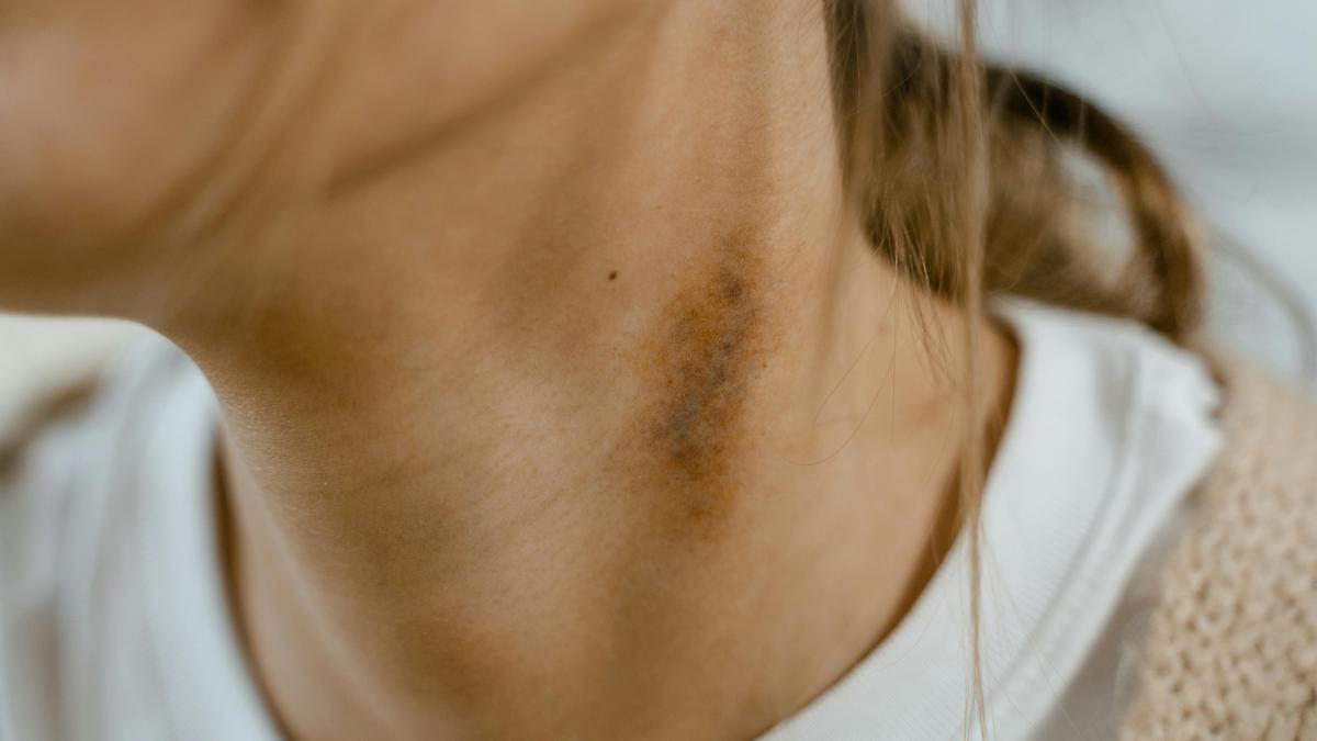 Cara Menghilangkan Bekas Luka Bakar tanpa Ribet