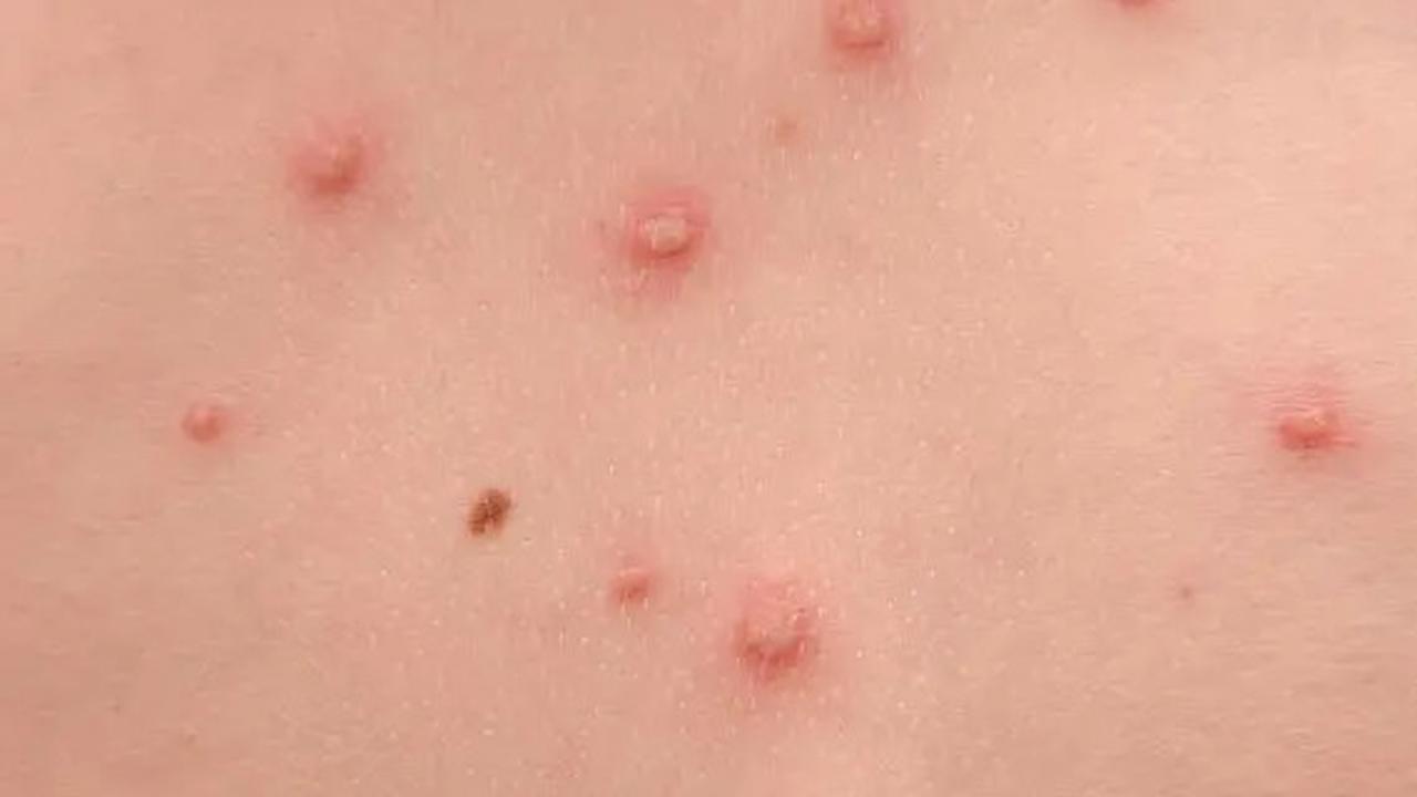 Mudah Menular, Begini Cara Mencegah Terjangkit Cacar Air dan Gondongan