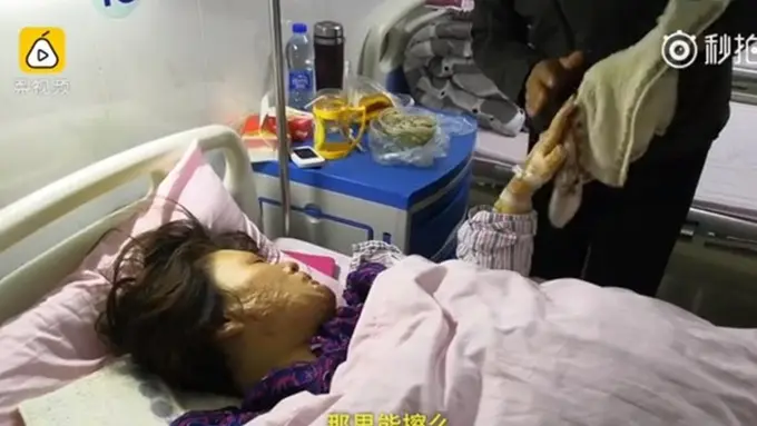 [Bintang] Diceraikan Suami Usai Wajah Terbakar, Kisah Wanita Ini Jadi Viral