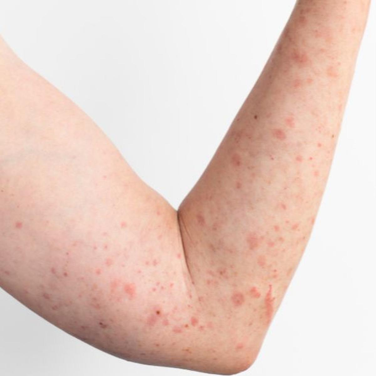 Mpox