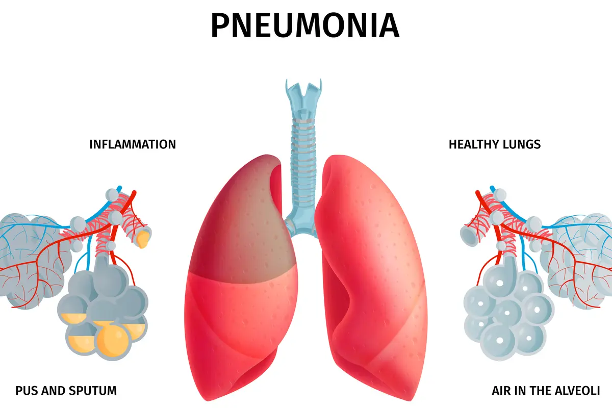 Ilustrasi pneumonia