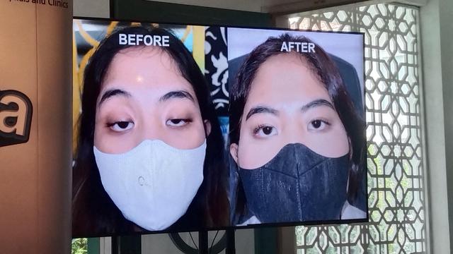 Sempat Viral di TikTok, Pricillia Bagikan Cerita Mata Ngantuk-nya Hingga Putuskan Untuk Operasi