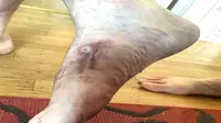 Seorang pria mempublikasikan gambar melalui foto mengenai sebuah sekrup yang muncul dari kakinya setelah menjalani operasi sembilan bulan si