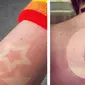 Sunburn tattoo (Sumber: Instagram @funtantattoo dan @_cheesegerd_)