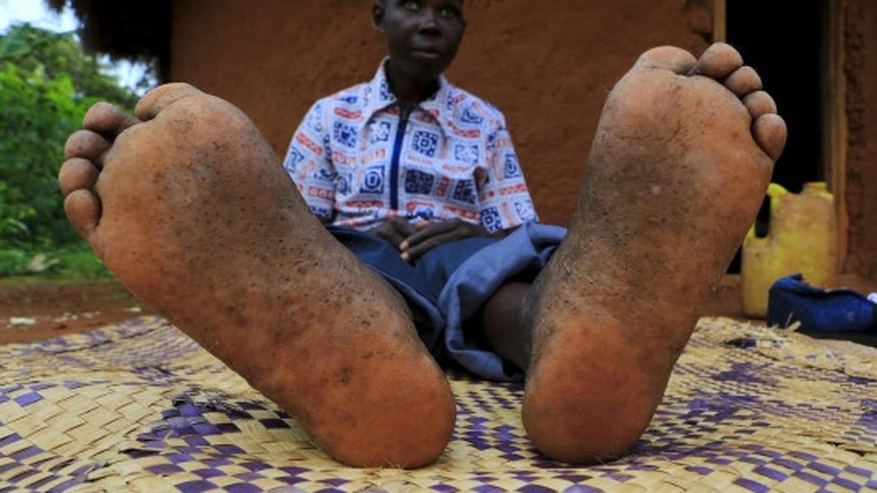 Derita warga Uganda terinfeksi kutu pengisap darah Jigger