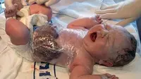 Seorang bayi yang lahir dengan usus dan kandung kemih di luar tubuh