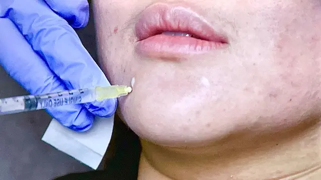 prosedur Filler dan botox