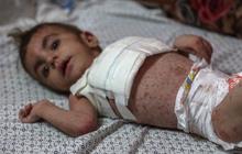 FOTO: Nestapa Anak-Anak Palestina Terpapar Penyakit Kulit Berbahaya karena Krisis Air Bersih di Jalur Gaza