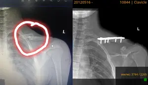 Pelajar SMP di Lampung Selatan Dibully Teman hingga Bahu Patah