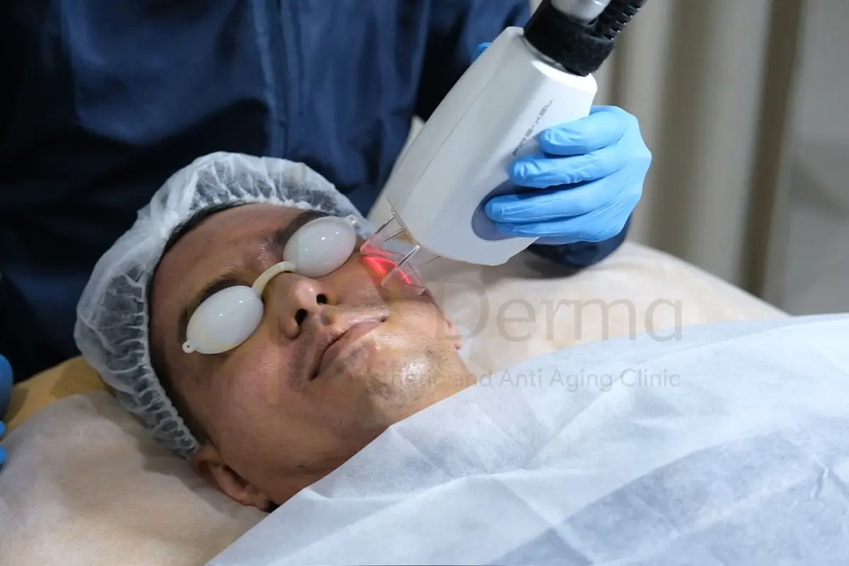Penggunaan Laser CO2 Fractional