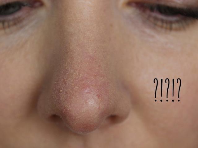 Solusi Cantik Untuk Atasi Kulit Kering Di Sekitar Hidung Health Liputan6 Com
