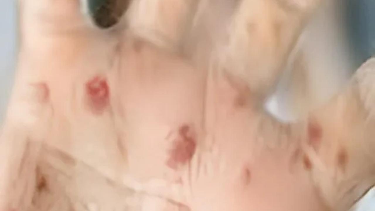 Adapun seluruh pasien merupakan laki-laki berusia 25-50 tahun. Mereka tertular dari kontak seksual.<br>