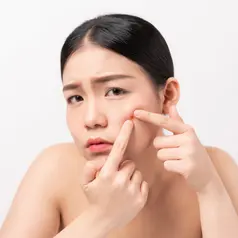 Ilustrasi Kulit Berjerawat Credit: pexels.com/Laluna