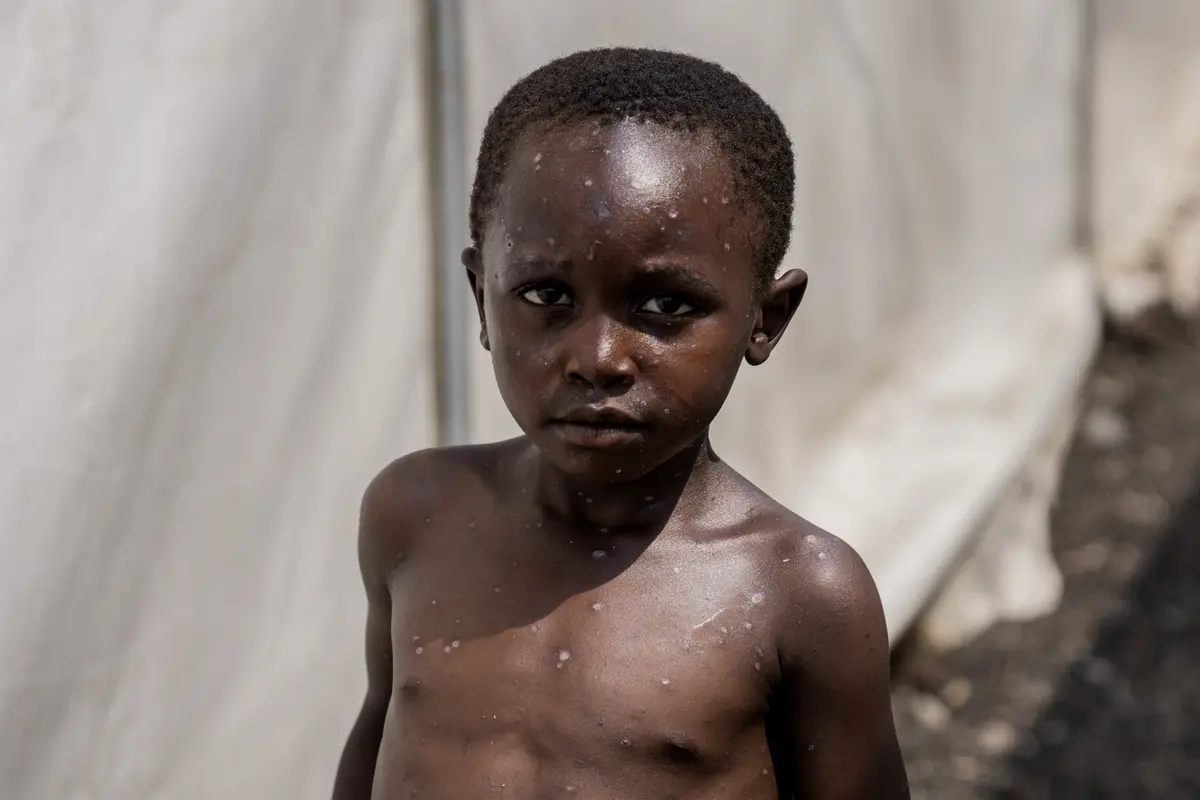 Kongo akan menerima vaksin mpox pertama