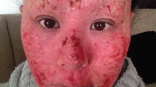 Kisah Perjuangan Wanita Atasi Eksim Hingga Membuat Wajahnya Berubah Ini Bikin Pilu