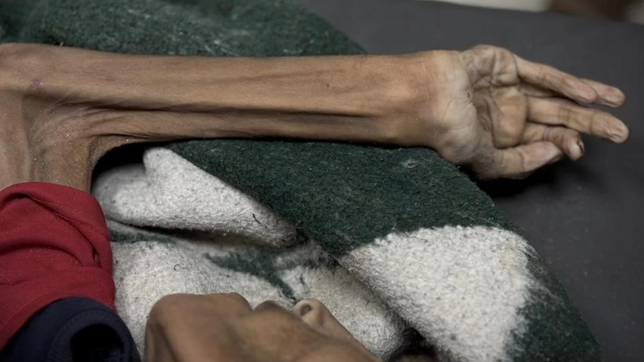 Dalam 1 Hari 15 Warga Gaza Meninggal karena Kelaparan, Bobot Tubuh Hanya 12 Kilogram