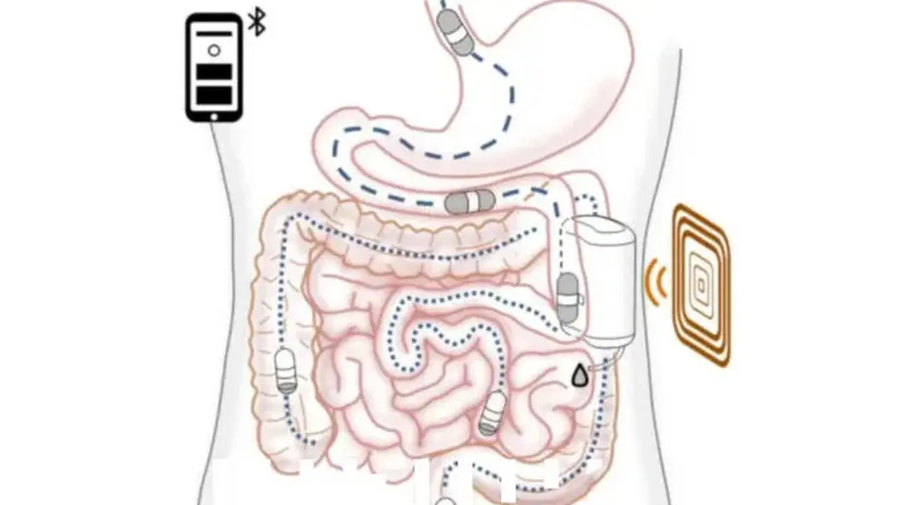Robot kecil untuk menyuntikkan insulin di dalam perut pasien diabetes. Dok: Sant’Anna School of Advanced Studies