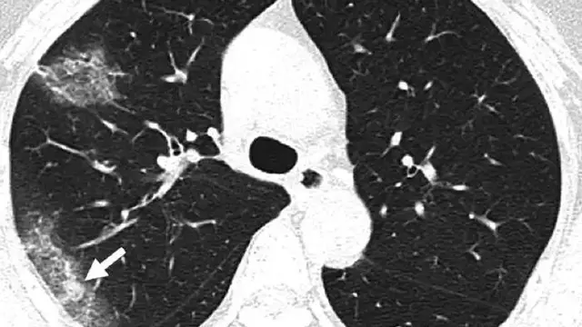 ilustrasi paru-paru/credit Weifang Kong and Prachi P. Agarwal