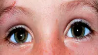 Bintik putih pada mata anak bisa berpotensi retinoblastoma. (Ilustrasi: Mail Online)