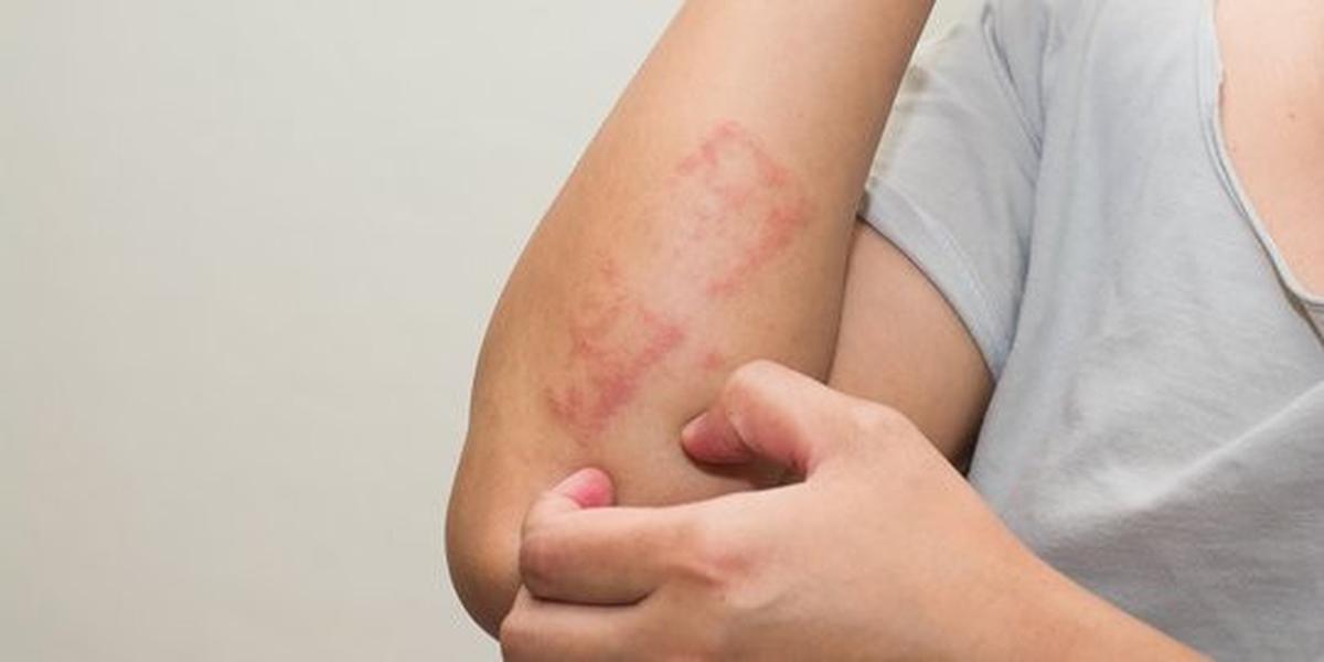 Dermatitis Kontak