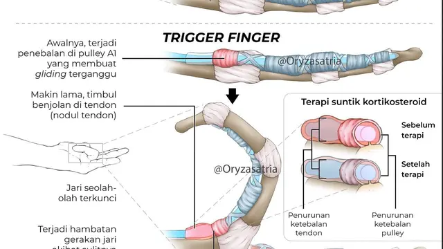 Trigger Finger