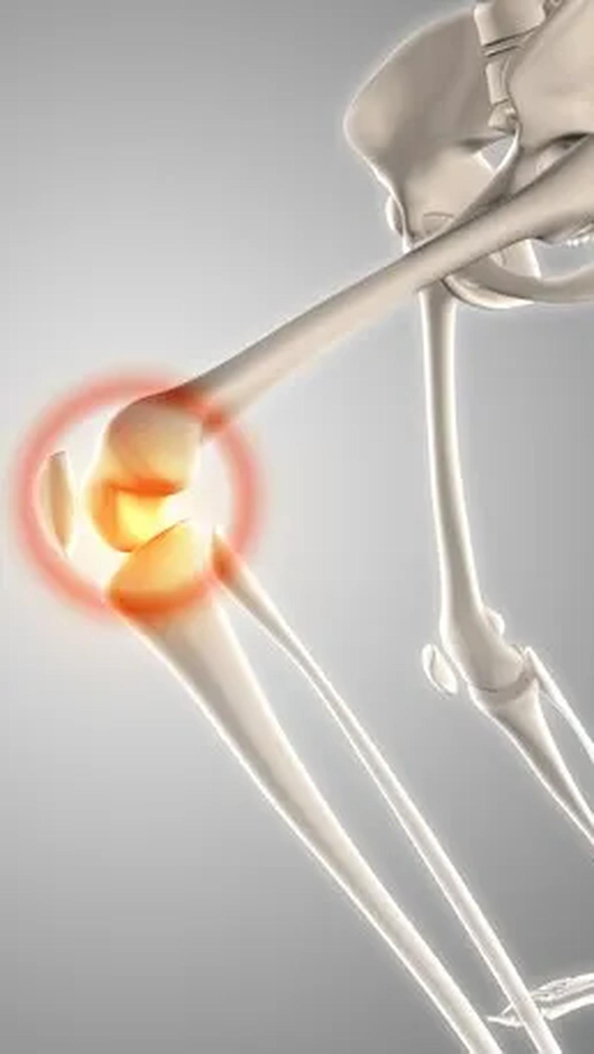 Hari ini, 20 Oktober, bukanlah hari biasa. Ini adalah Hari Osteoporosis Sedunia, sebuah acara puncak tahunan yang diselenggarakan oleh International Osteoporosis Foundation (IOF).&nbsp;