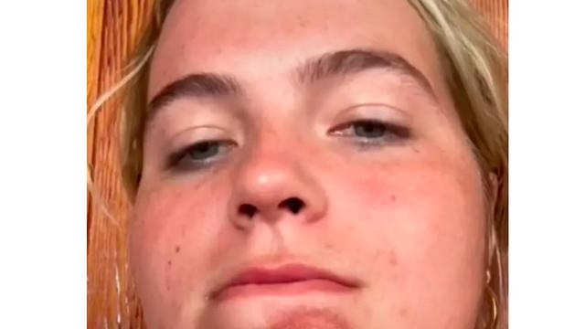 wanita terinfeksi usai cium pria berjanggut