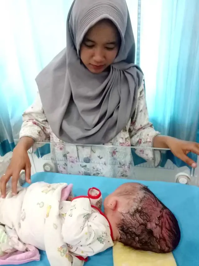 Bayi penderita hidrosefalus asal Kecamatan Karangpucung, Cilacap, Jawa Tengah butuh bantuan. (Foto: Liputan6.com/FB/Muhamad Ridlo)
