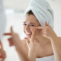 ilustrasi kandungan spot treatment yang ampuh mengatasi jerawat/Pressmaster/shutterstock