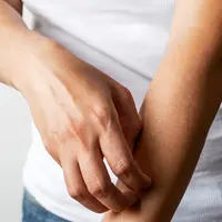 ilustrasi resep ramuan alami yang bisa menyembuhkan gatal di kulit/pixabay