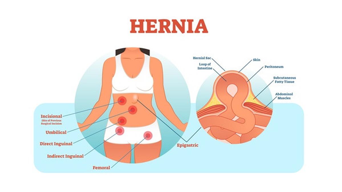 8 Jenis Hernia dan Cara Pengobatannya 