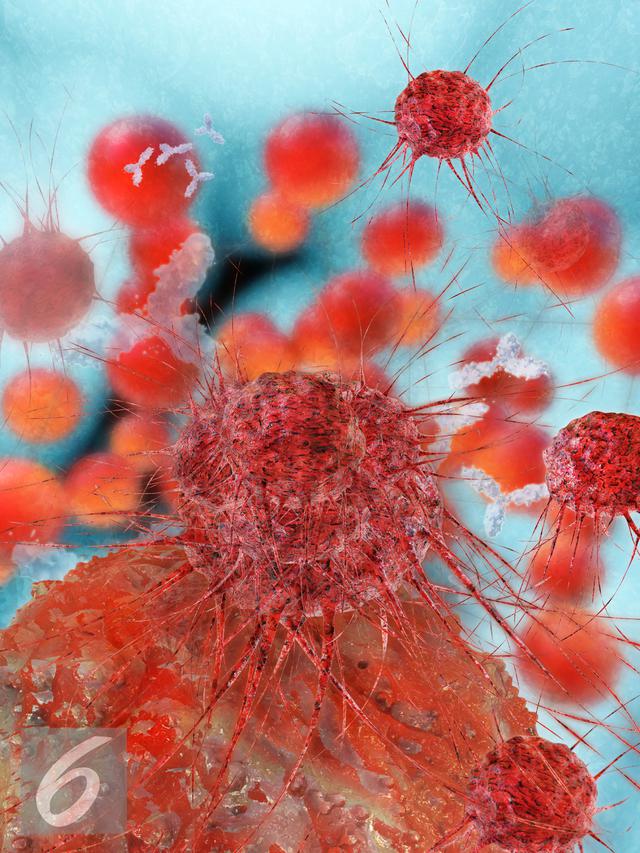 Ilustrasi Kanker Payudara