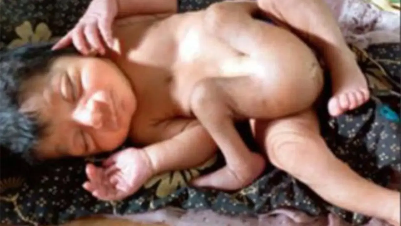 Bayi dengan Empat Kaki dan Dua Kelamin Buat Geger Warga